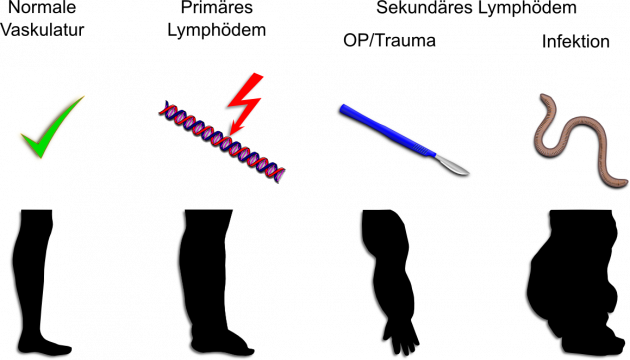 Causes of primary and secondary lymphedema