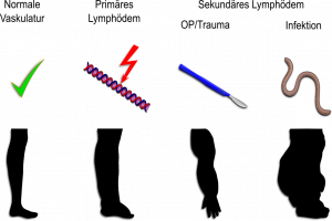Ursachen der primären und sekundären Lymphödeme